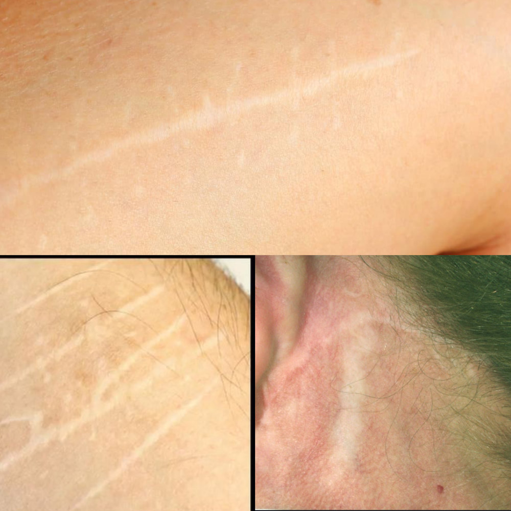 Marika Permanent Makeup Scar camouflaging